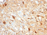 IHC staining of FFPE human liver tissue with recombinant ALB antibody (clone rALB/6410). HIER: boil tissue sections in pH 9 10mM Tris with 1mM EDTA for 20 min and allow to cool before testing.