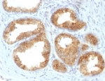 IHC staining of FFPE human prostate cancer with COX2 antibody (clone COX2/2377). HIER: boil tissue sections in pH 9 10mM Tris with 1mM EDTA for 20 min and allow to cool before testing.