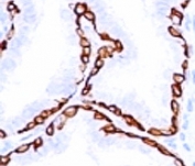 IHC: Formalin-fixed, paraffin-embedded human prostate carcinoma stained with anti-Cytokeratin 14 antibody (clone SPM263).