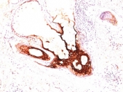 IHC: Formalin-fixed, paraffin-embedded human skin stained with CK17 antibody (clone SPM560).
