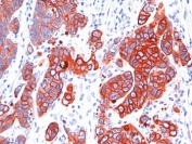 IHC: Formalin-fixed, paraffin-embedded human colon carcinoma stained with anti-Multi Cytokeratin antibody (SPM583).