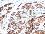 IHC staining of FFPE human breast carcinoma tissue with recombinant Mucin-1 antibody (clone MUC1/4416R). HIER: boil tissue sections in pH 9 10mM Tris with 1mM EDTA for 20 min and allow to cool before testing.