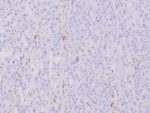 IHC staining of FFPE human Hereditary Nonpolyposis Colorectal Cancer (HNPCC) with recombinant MLH1 antibody (MLH1/6284R) at 2ug/ml.