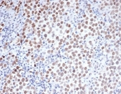 IHC staining of FFPE human seminoma with Oct4 antibody (clone Oct4/3508). HIER: boil tissue sections in pH 9 10mM Tris with 1mM EDTA for 20 min and allow to cool before testing.