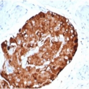 IHC staining of FFPE human testicular carcinoma with recombinant INHA antibody (clone rINHA/6919) at 2ug/ml in PBS for 30min RT. HIER: boil tissue sections in pH 9 10mM Tris with 1mM EDTA for 20 min and allow to cool before testing.