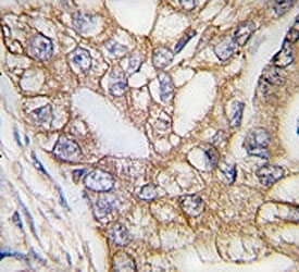 IHC analysis of FFPE human lung carcinoma tissue stained with Ihh antibody