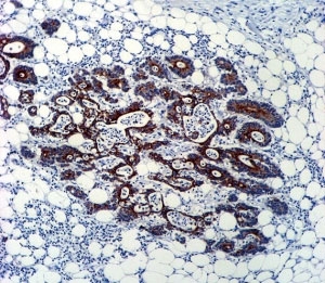 TGFB2 antibody immunohsitochemistry analysis in formalin fixed and paraffin embedded human colon carcinoma