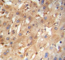 NEU4 antibody immunohistochemistry analysis in formalin fixed and paraffin embedded human hepatocarcinoma.