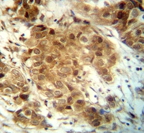 FOXO3 antibody immunohistochemistry analysis in formalin fixed and paraffin embedded human breast carcinoma.