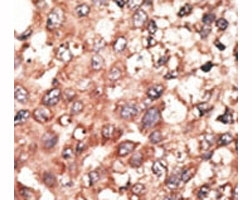 IHC analysis of FFPE human hepatocarcinoma tissue stained with the BMP5 antibody