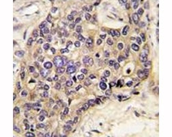 IHC analysis of FFPE human hepatocarcinoma tissue stained with HGF antibody