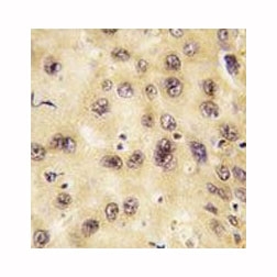 IHC analysis of FFPE human hepatocarcinoma tissue stained with PROX1 antibody