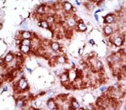 IHC analysis of FFPE human hepatocarcinoma tissue stained with the CPT1B antibody