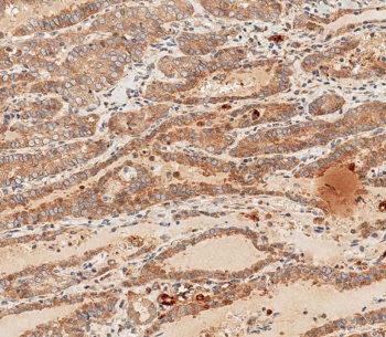 IHC staining of FFPE human thyroid carcinoma with WNT5A antibody. HIER: boil tissue sections in pH 9 EDTA for 20 min and allow to cool before testing.