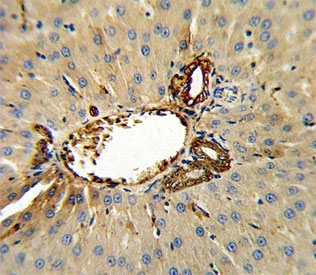 Annexin V antibody IHC analysis in formalin fixed and paraffin embedded human hepatocarcinoma.