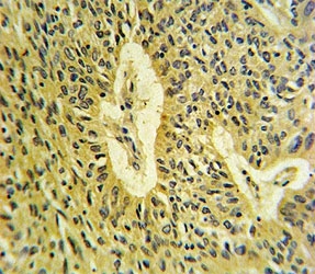 SMAD7 antibody IHC analysis in formalin fixed and paraffin embedded lung carcinoma.