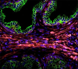 Confocal immunofluorescent analysis of Cytokeratin-18 antibody with prostate carcinoma followed by Alexa Fluor 488-conjugated goat anti-rabbit lgG (green). DAPI was used as a nuclear counterstain (blue).