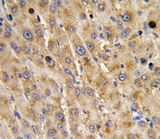 IHC analysis of FFPE human hepatocarcinoma with ADAMTS13 antibody