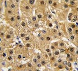 IHC analysis of FFPE human hepatocarcinoma tissue stained with c-Abl antibody