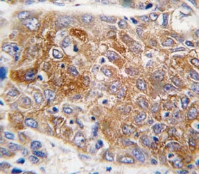 IHC analysis of FFPE human hepatocarcinoma tissue stained with ALDH1L1 antibody