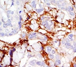 IHC analysis of FFPE human breast carcinoma tissue stained with the PAK3 antibody