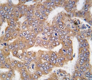 IHC analysis of FFPE human prostate carcinoma tissue stained with PAK4 antibody