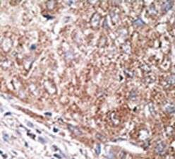 IHC analysis of FFPE human hepatocarcinoma tissue stained with the Nestin antibody.
