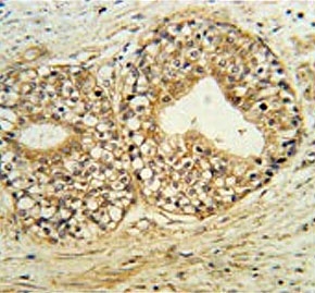IHC testing of FFPE human prostate carcinoma tissue with Phospholipid-transporting ATPase IG antibody. HIER: steam section in pH6 citrate buffer for 20 min and allow to cool prior to staining.