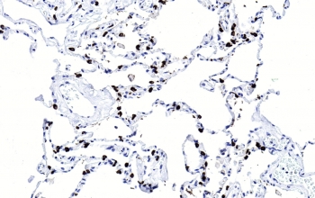 IHC testing of FFPE human lung tissue with SFTPC antibody. HIER: steam section in pH6 citrate buffer for 20 min and allow to cool prior to staining.