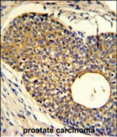 IHC staining of FFPE human prostate carcinoma tissue with Phorbolin 1 antibody. HIER: steam section in pH6 citrate buffer for 20 min and allow to cool prior to staining.