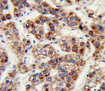 IHC staining of FFPE human hepatocarcinoma tissue with Ornithine transcarbamylase antibody. HIER: steam section in pH6 citrate buffer for 20 min and allow to cool prior to staining.