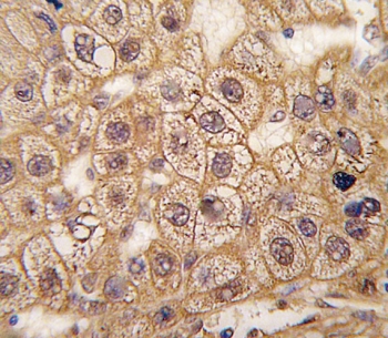 IHC staining of FFPE human hepatocarcinoma tissue with B2AR antibody. HIER: steam section in pH6 citrate buffer for 20 min and allow to cool prior to staining.