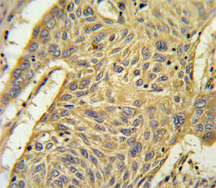 IHC staining of FFPE human lung carcinoma tissue with AGER antibody. HIER: steam section in pH6 citrate buffer for 20 min and allow to cool prior to staining.