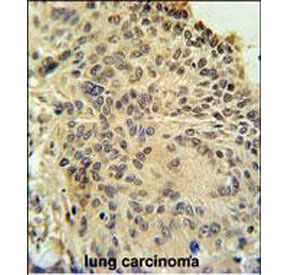 IHC staining of FFPE human lung carcinoma tissue with RSPO2 antibody. HIER: steam section in pH6 citrate buffer for 20 min and allow to cool prior to staining.