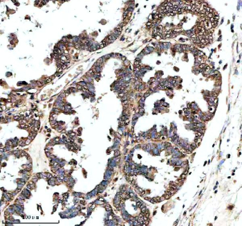 IHC analysis of GHRHR using anti-GHRHR antibody. GHRHR was detected in a paraffin-embedded section of human ovarian cancer tissue. Heat mediated antigen retrieval was performed in EDTA buffer (pH 8.0, epitope retrieval solution). The tissue section was blocked with 10% goat serum. The tissue section was then incubated with 2 ug/ml rabbit anti-GHRHR antibody overnight at 4oC. Peroxidase Conjugated Goat Anti-rabbit IgG was used as secondary antibody and incubated for 30 minutes at 37oC. The tissue section was developed using an HRP secondary and DAB substrate.