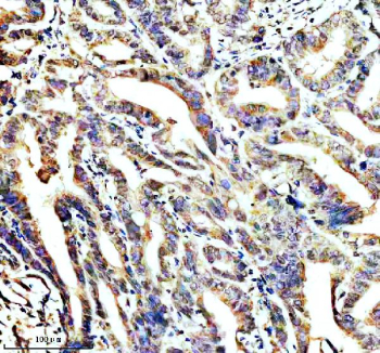 IHC staining of STOML2 using anti-STOML2 antibody. STOML2 was detected in a paraffin-embedded section of human colon cancer tissue. Heat mediated antigen retrieval was performed in EDTA buffer (pH 8.0, epitope retrieval solution). The tissue section was blocked with 10% goat serum. The tissue section was then incubated with 2 ug/ml rabbit anti-STOML2 antibody overnight at 4oC. Peroxidase Conjugated Goat Anti-rabbit IgG was used as secondary antibody and incubated for 30 minutes at 37oC. The tissue section was developed using an HRP secondary and DAB substrate.