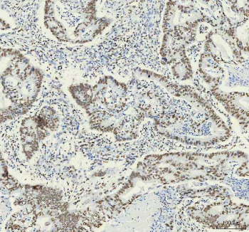IHC analysis of HNRNPM using anti-HNRNPM antibody. HNRNPM was detected in a paraffin-embedded section of human rectal cancer tissue. Heat mediated antigen retrieval was performed in EDTA buffer (pH 8.0, epitope retrieval solution). The tissue section was blocked with 10% goat serum. The tissue section was then incubated with 1:50 rabbit anti-HNRNPM antibody overnight at 4oC. Peroxidase Conjugated Goat Anti-rabbit IgG was used as secondary antibody and incubated for 30 minutes at 37oC. The tissue section was developed using an HRP secondary and DAB substrate.