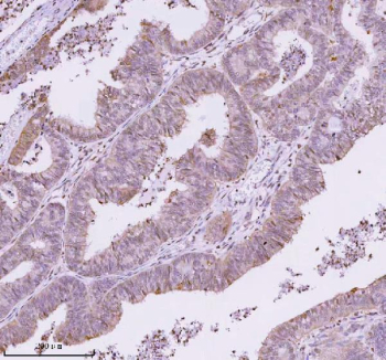 IHC analysis of RBBP8 using anti-RBBP8 antibody. RBBP8 was detected in a paraffin-embedded section of human endometrioid adenocarcinoma tissue. Heat mediated antigen retrieval was performed in EDTA buffer (pH 8.0, epitope retrieval solution). The tissue section was blocked with 10% goat serum. The tissue section was then incubated with 2 ug/ml rabbit anti-RBBP8 antibody overnight at 4oC. Peroxidase Conjugated Goat Anti-rabbit IgG was used as secondary antibody and incubated for 30 minutes at 37oC. The tissue section was developed using an HRP secondary and DAB substrate.