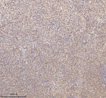 IHC analysis of SSX2IP using anti-SSX2IP antibody. SSX2IP was detected in a paraffin-embedded section of human cervix squamous cell carcinoma tissue. Heat mediated antigen retrieval was performed in EDTA buffer (pH 8.0, epitope retrieval solution). The tissue section was blocked with 10% goat serum. The tissue section was then incubated with 2 ug/ml rabbit anti-SSX2IP antibody overnight at 4oC. Peroxidase Conjugated Goat Anti-rabbit IgG was used as secondary antibody and incubated for 30 minutes at 37oC. The tissue section was developed using an HRP secondary and DAB substrate.