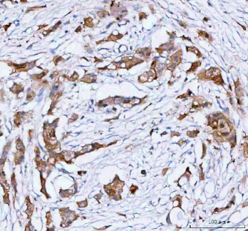 IHC analysis of PHGDH using anti-PHGDH antibody. PHGDH was detected in a paraffin-embedded section of human breast cancer tissue. Heat mediated antigen retrieval was performed in EDTA buffer (pH 8.0, epitope retrieval solution). The tissue section was blocked with 10% goat serum. The tissue section was then incubated with 2 ug/ml rabbit anti-PHGDH antibody overnight at 4oC. Peroxidase Conjugated Goat Anti-rabbit IgG was used as secondary antibody and incubated for 30 minutes at 37oC. The tissue section was developed using an HRP secondary and DAB substrate.