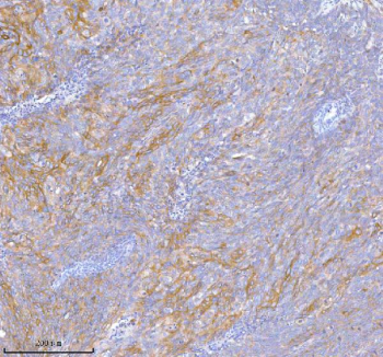 Immunohistochemical staining of TNIK using anti-TNIK antibody. TNIK was detected in a paraffin-embedded section of human cervix squamous cell carcinoma tissue. Heat mediated antigen retrieval was performed in EDTA buffer (pH 8.0, epitope retrieval solution). The tissue section was blocked with 10% goat serum. The tissue section was then incubated with 2 ug/ml rabbit anti-TNIK antibody overnight at 4oC. Peroxidase Conjugated Goat Anti-rabbit IgG was used as secondary antibody and incubated for 30 minutes at 37oC. The tissue section was developed using an HRP secondary and DAB substrate.