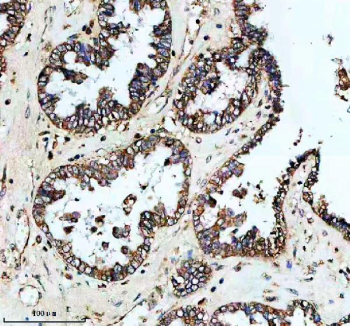 Immunohistochemical staining of PLIN5 using anti-PLIN5 antibody. PLIN5 was detected in a paraffin-embedded section of human ovarian cancer tissue. Heat mediated antigen retrieval was performed in EDTA buffer (pH 8.0, epitope retrieval solution). The tissue section was blocked with 10% goat serum. The tissue section was then incubated with 2 ug/ml rabbit anti-PLIN5 antibody overnight at 4oC. Peroxidase Conjugated Goat Anti-rabbit IgG was used as secondary antibody and incubated for 30 minutes at 37oC. The tissue section was developed using an HRP secondary and DAB substrate.