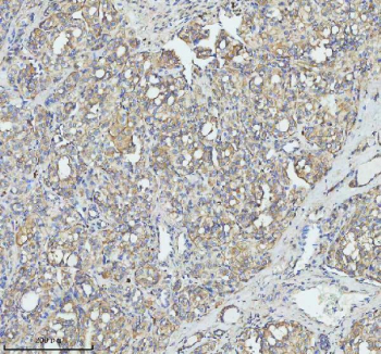 Immunohistochemical staining of TOM1 using anti-TOM1 antibody. TOM1 was detected in a paraffin-embedded section of human thyroid cancer tissue. Heat mediated antigen retrieval was performed in EDTA buffer (pH 8.0, epitope retrieval solution). The tissue section was blocked with 10% goat serum. The tissue section was then incubated with 2 ug/ml rabbit anti-TOM1 antibody overnight at 4oC. Peroxidase Conjugated Goat Anti-rabbit IgG was used as secondary antibody and incubated for 30 minutes at 37oC. The tissue section was developed using an HRP secondary and DAB substrate.