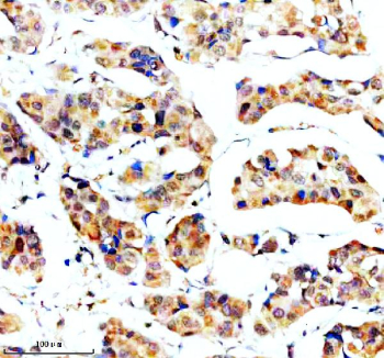 Immunohistochemical staining of SORL1 using anti-SORL1 antibody. SORL1 was detected in a paraffin-embedded section of human breast cancer tissue. Heat mediated antigen retrieval was performed in EDTA buffer (pH 8.0, epitope retrieval solution). The tissue section was blocked with 10% goat serum. The tissue section was then incubated with 2 ug/ml rabbit anti-SORL1 antibody overnight at 4oC. Peroxidase Conjugated Goat Anti-rabbit IgG was used as secondary antibody and incubated for 30 minutes at 37oC. The tissue section was developed using an HRP secondary and DAB substrate.