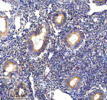 Immunohistochemical staining of PALS1 using anti-PALS1 antibody. PALS1 was detected in a paraffin-embedded section of human endometrial cancer tissue. Heat mediated antigen retrieval was performed in EDTA buffer (pH 8.0, epitope retrieval solution). The tissue section was blocked with 10% goat serum. The tissue section was then incubated with 2 ug/ml rabbit anti-PALS1 antibody overnight at 4oC. Peroxidase Conjugated Goat Anti-rabbit IgG was used as secondary antibody and incubated for 30 minutes at 37oC. The tissue section was developed using an HRP secondary and DAB substrate.