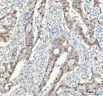 Immunohistochemical staining of FAM50A using anti-FAM50A antibody. FAM50A was detected in a paraffin-embedded section of human colorectal adenocarcinoma tissue. Heat mediated antigen retrieval was performed in EDTA buffer (pH 8.0, epitope retrieval solution). The tissue section was blocked with 10% goat serum. The tissue section was then incubated with 1:50 rabbit anti-FAM50A antibody overnight at 4oC. Peroxidase Conjugated Goat Anti-rabbit IgG was used as secondary antibody and incubated for 30 minutes at 37oC. The tissue section was developed using an HRP secondary and DAB substrate.