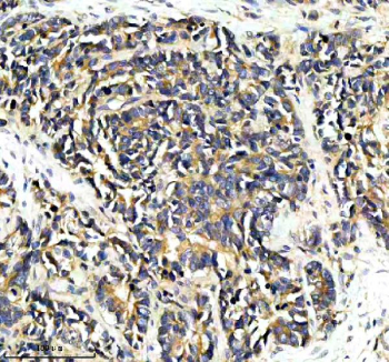 Immunohistochemical staining of PPP2R5E using anti-PPP2R5E antibody. PPP2R5E was detected in a paraffin-embedded section of human colon cancer tissue. Heat mediated antigen retrieval was performed in EDTA buffer (pH 8.0, epitope retrieval solution). The tissue section was blocked with 10% goat serum. The tissue section was then incubated with 2 ug/ml rabbit anti-PPP2R5E antibody overnight at 4oC. Peroxidase Conjugated Goat Anti-rabbit IgG was used as secondary antibody and incubated for 30 minutes at 37oC. The tissue section was developed using an HRP secondary and DAB substrate.