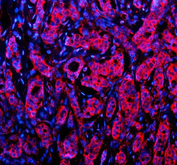 Immunofluorescent staining of NID1 using anti-NID1 antibody (red). NID1 was detected in a paraffin-embedded section of human breast cancer tissue. Heat mediated antigen retrieval was performed in EDTA buffer (pH 8.0, epitope retrieval solution). The tissue section was blocked with 10% goat serum. The tissue section was then incubated with 5 ug/ml rabbit anti-NID1 antibody overnight at 4oC. Cy3 Conjugated Goat Anti-Rabbit IgG was used as secondary antibody at 1:500 dilution and incubated for 30 minutes at 37oC. The section was counterstained with DAPI nuclear stain (blue). Visualize using a fluorescence microscope and filter sets appropriate for the label used.