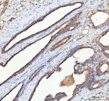 Immunohistochemical staining of RHOT2 using anti-RHOT2 antibody. RHOT2 was detected in a paraffin-embedded section of human prostate cancer tissue. Heat mediated antigen retrieval was performed in EDTA buffer (pH 8.0, epitope retrieval solution). The tissue section was blocked with 10% goat serum. The tissue section was then incubated with 2 ug/ml rabbit anti-RHOT2 antibody overnight at 4oC. Peroxidase Conjugated Goat Anti-rabbit IgG was used as secondary antibody and incubated for 30 minutes at 37oC. The tissue section was developed using an HRP secondary and DAB substrate.