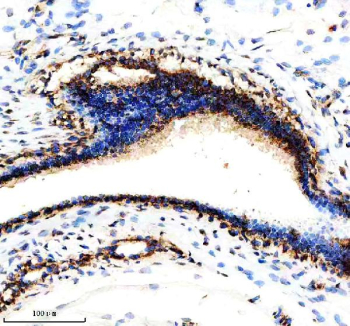 Immunohistochemical staining of NDUFS3 using anti-NDUFS3 antibody. NDUFS3 was detected in a paraffin-embedded section of human breast cancer tissue. Heat mediated antigen retrieval was performed in EDTA buffer (pH 8.0, epitope retrieval solution). The tissue section was blocked with 10% goat serum. The tissue section was then incubated with 2 ug/ml rabbit anti-NDUFS3 antibody overnight at 4oC. Peroxidase Conjugated Goat Anti-rabbit IgG was used as secondary antibody and incubated for 30 minutes at 37oC. The tissue section was developed using an HRP secondary and DAB substrate.